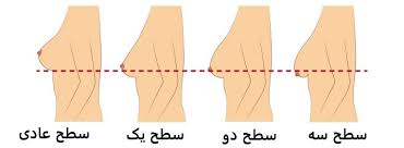 افتادگی سینه بانوان